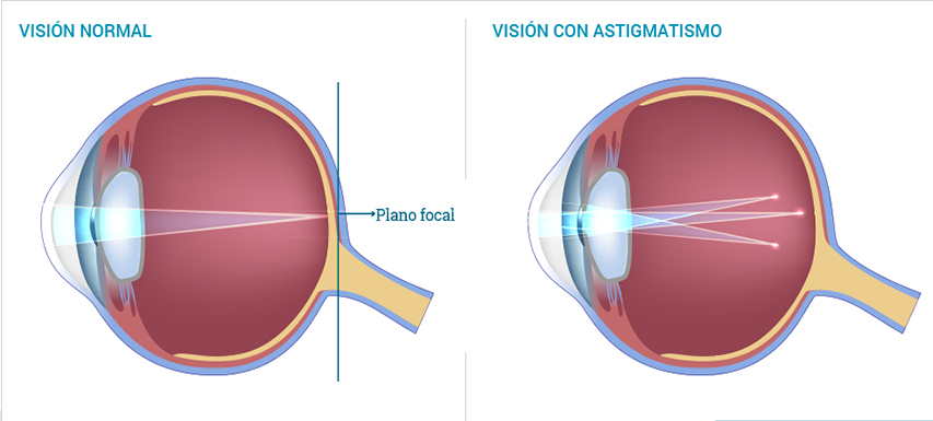 astigmatism oftalmologic
